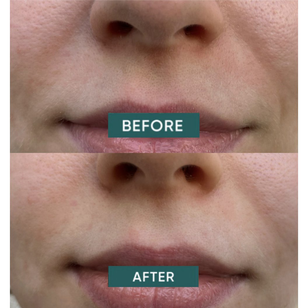APRICOT Cotton Mouth Patches with Hyaluron - Mini Pack