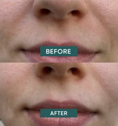 APRICOT Cotton Mouth Patches with Hyaluron - Mini Pack