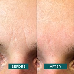 APRICOT Cotton Facial Patches with Hyaluron - Mini Pack