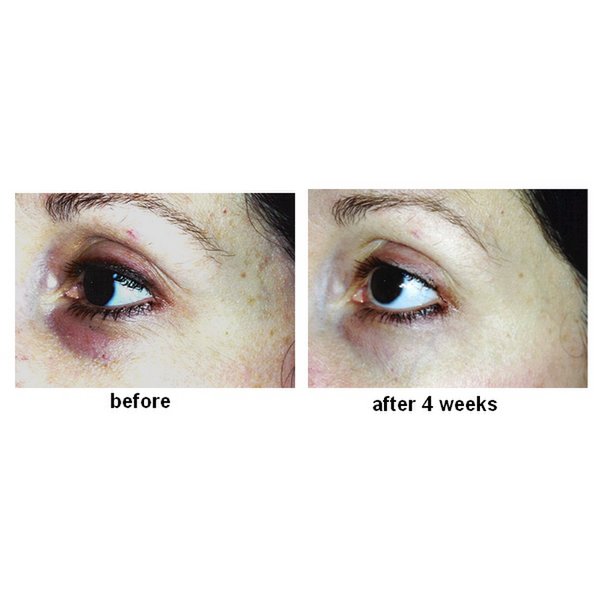 EYE BAGS STOP - reducerer poser og ringe under øjnene