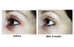 EYE BAGS STOP - reducerer poser og ringe under øjnene