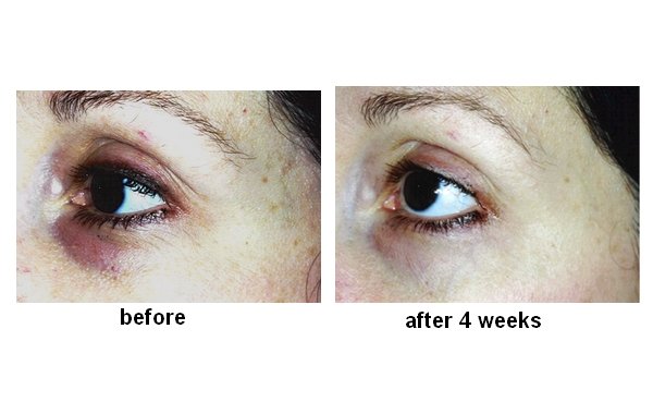 EYE BAGS STOP - reducerer poser og ringe under øjnene