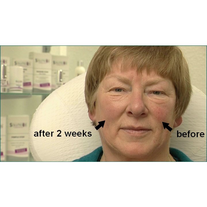 CAPILLARY STOP - riduce gli arrossamenti del viso, contro couperose, rosacea e capillari rotti