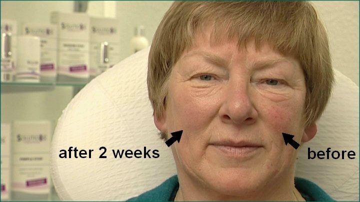 CAPILLARY STOP - riduce gli arrossamenti del viso, contro couperose, rosacea e capillari rotti