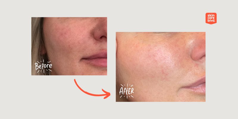 Synbiotic Skin Serum med probiotika