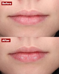 NOUVEAU Baume Repulpant 100% Naturel : Acide Hyaluronique & Collagène