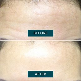 NEW - APRICOT Reusable Forehead Pad with Hexapeptide Technology
