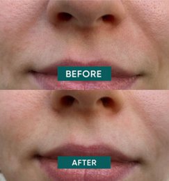 APRICOT Cotton Mouth Patches with Niacinamide