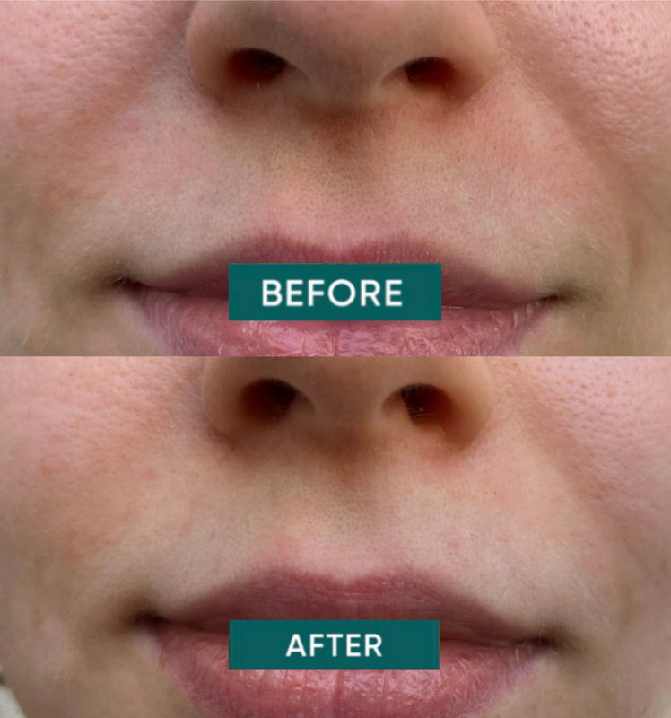 APRICOT Cotton Mouth Patches with Niacinamide
