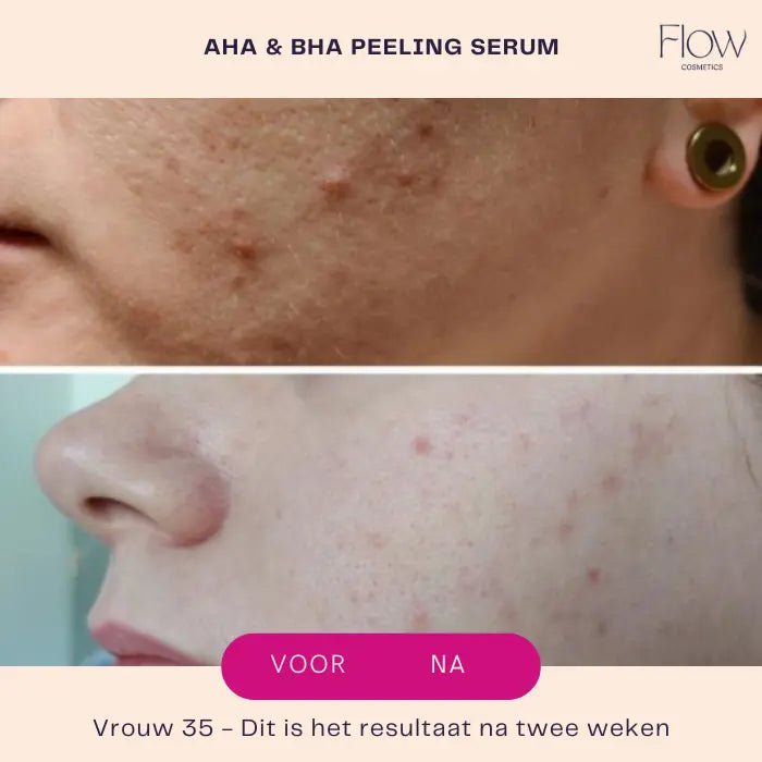 AHA & BHA Peeling Serum - Peeling face