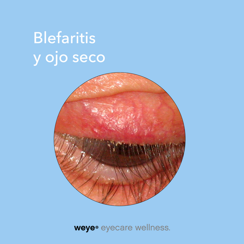 Weye-Gel