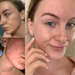 Argan Acne Rehab Serum 30ml