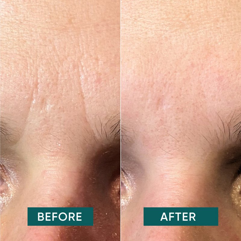 APRICOT Cotton Facial Patches with Hyaluron