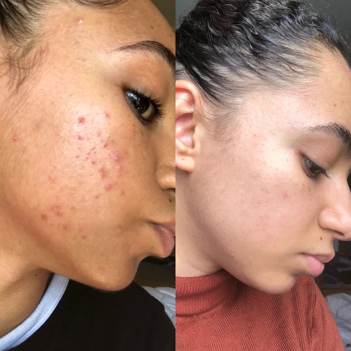 Argan Acne Rehab Serum 30ml