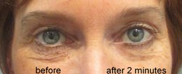 SUPREME DIRECT EYE LIFT - sofortiges Augenlifting - Ergebnisse in 2 Minuten