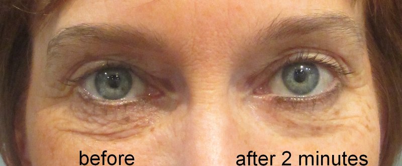 SUPREME DIRECT EYE LIFT - sofortiges Augenlifting - Ergebnisse in 2 Minuten