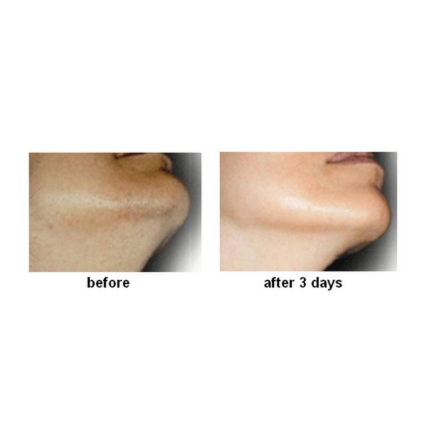 INGROW STOP - against ingrown hairs and shaving rash, men/women