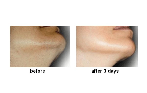 INGROW STOP - against ingrown hairs and shaving rash, men/women