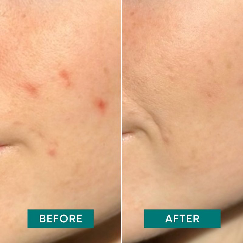APRICOT Pimple Patches