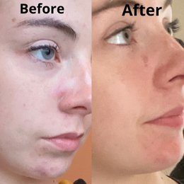 Argan Acne Rehab Serum 30ml