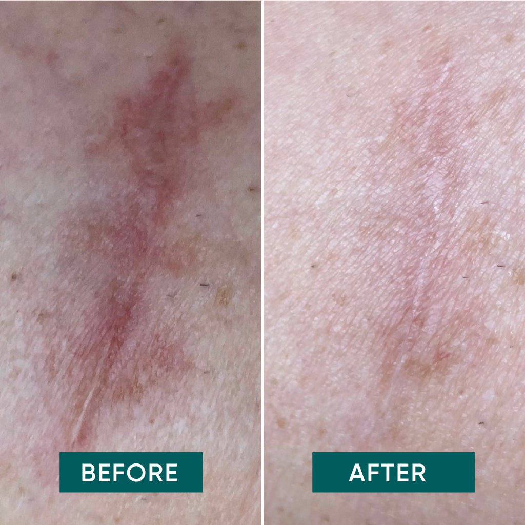 APRICOT Reusable Mini Scar Pads with Aloe Vera