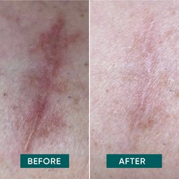 APRICOT Reusable Mini Scar Pads with Aloe Vera