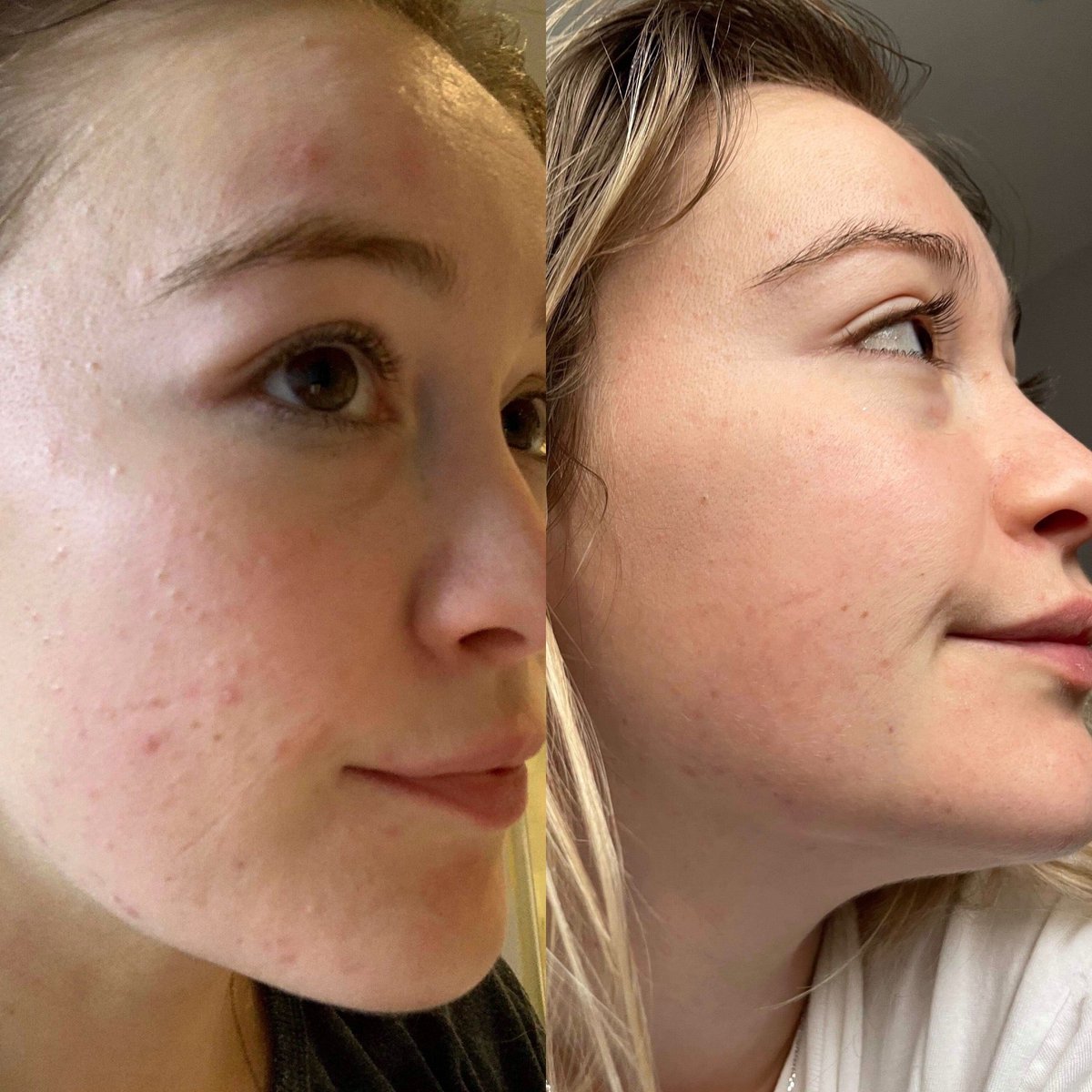Argan Acne Rehab Serum 30ml