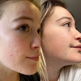 Argan Acne Rehab Serum 30ml
