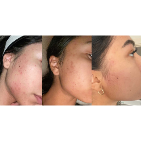 Argan Acne Rehab Serum 30ml