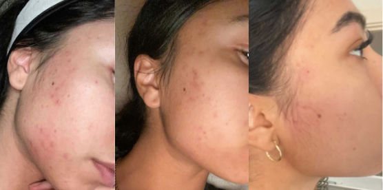 Argan Acne Rehab Serum 30ml